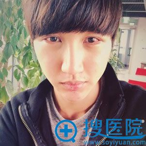 韩国男生做全切双眼皮第5天图 韩国男生做全切双眼皮第5天图