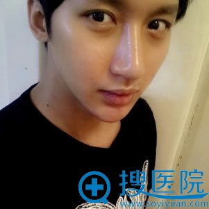 男生自体脂肪填充术后2周图 男生自体脂肪填充术后2周图