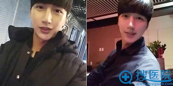 韩国男生做自体脂肪填充全脸1个月 韩国男生做自体脂肪填充全脸1个月