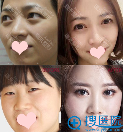 <!--<i data=20240710 data-id=13548></i>-->医院双眼皮案例 <!--<i data=20240710 data-id=13548></i>-->医院双眼皮案例