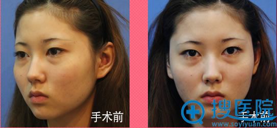 在韩国一见整形外科整容术前照 在韩国一见整形外科整容术前照