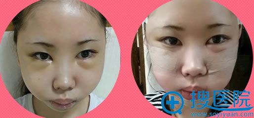 在韩国一见做面部轮廓术后第3天照片 在韩国一见做面部轮廓术后第3天照片