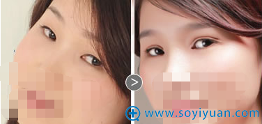 泉州美莱华美整形美容医院韩式8度双眼皮 泉州美莱华美整形美容医院韩式8度双眼皮