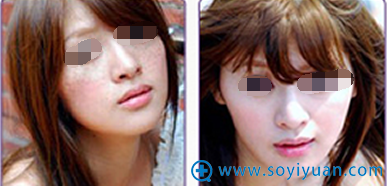 泉州美莱华美整形美容医院美肤祛斑案例 泉州美莱华美整形美容医院美肤祛斑案例