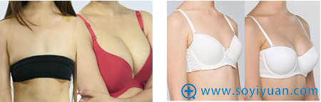 泉州海峡整形美容医院沸腾沟丰胸案例 泉州海峡整形美容医院沸腾沟丰胸案例