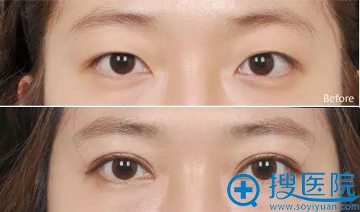 <!--<i data=20240710 data-id=11168></i>-->双眼皮效果案例图 <!--<i data=20240710 data-id=11168></i>-->双眼皮效果案例图