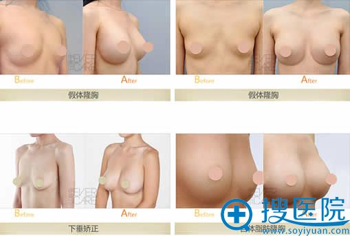伊美尔隆胸术前后效果对比图 伊美尔隆胸术前后效果对比图