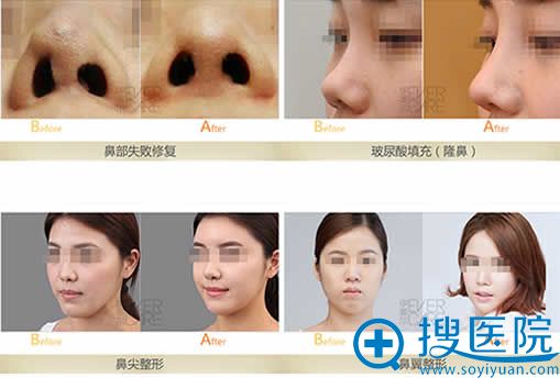 <!--<i data=20240710 data-id=11168></i>-->鼻整形前后效果对比图 <!--<i data=20240710 data-id=11168></i>-->鼻整形前后效果对比图