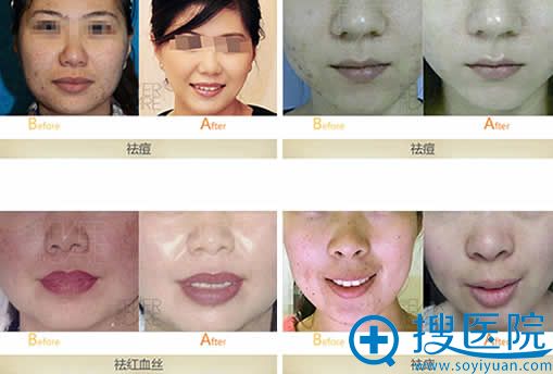 <!--<i data=20240710 data-id=11168></i>-->激光美肤效果图 <!--<i data=20240710 data-id=11168></i>-->激光美肤效果图