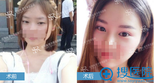 <!--<i data=20240710 data-id=16751></i>-->灵动翘睫双眼皮前后对比照 <!--<i data=20240710 data-id=16751></i>-->灵动翘睫双眼皮前后对比照