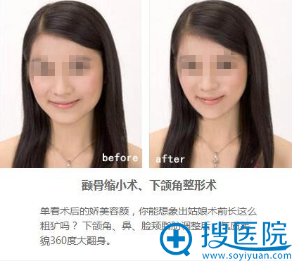 下颌角整形3 下颌角整形3