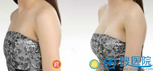 河南整形研究中心隆胸前后效果图 河南整形研究中心隆胸前后效果图