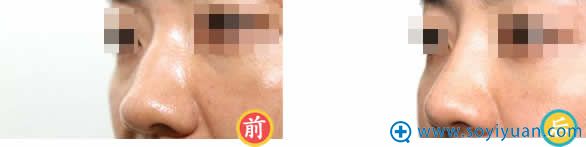 河南整形研究中心隆鼻前后效果 河南整形研究中心隆鼻前后效果