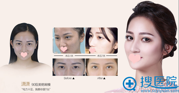 90后在昆明梦想做双眼皮恢复全过程 90后在昆明梦想做双眼皮恢复全过程