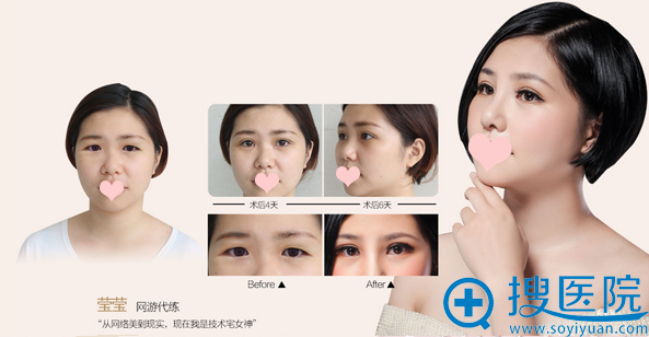 昆明梦想双眼皮前后对比案例图 昆明梦想双眼皮前后对比案例图