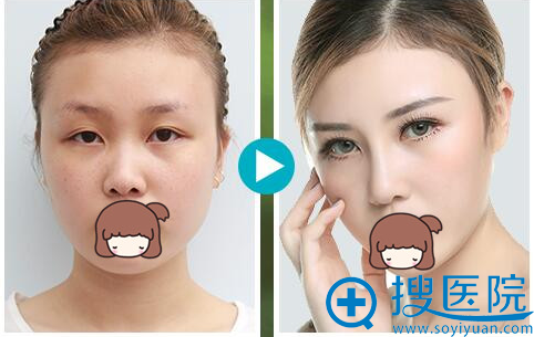 双眼皮+隆鼻 双眼皮+隆鼻