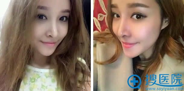 在武汉顶吉做鼻综合手术第20天图片 在武汉顶吉做鼻综合手术第20天图片