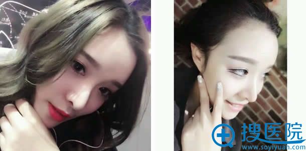 鼻综合整形手术恢复较终效果图 鼻综合整形手术恢复较终效果图