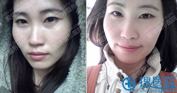 在韩国爱婷整形医院做面部轮廓术前照 在韩国爱婷整形医院做面部轮廓术前照