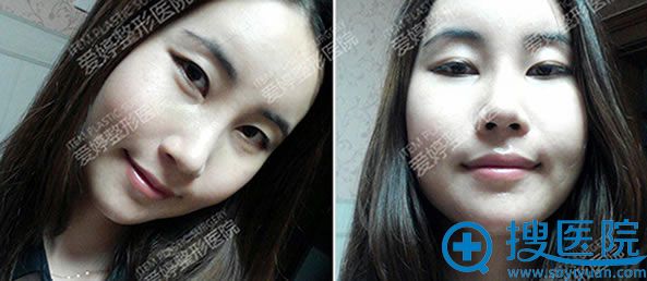 韩式隆鼻术后14天恢复效果 韩式隆鼻术后14天恢复效果