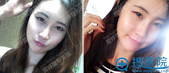 自体脂肪面部填充术后一个月美照 自体脂肪面部填充术后一个月美照