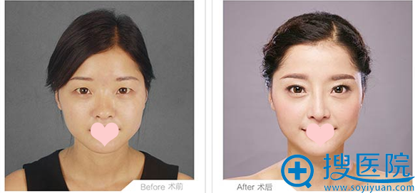 柳州华美双眼皮前后对比图 柳州华美双眼皮前后对比图