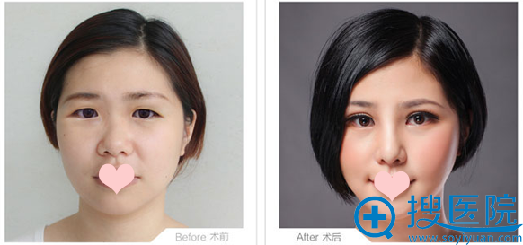 柳州华美双眼皮案例 柳州华美双眼皮案例