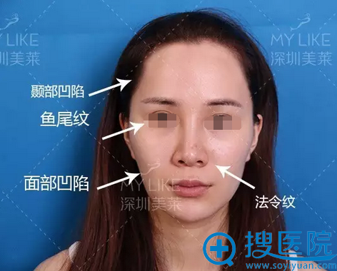 自体脂肪面部填充术前照片 自体脂肪面部填充术前照片