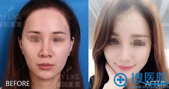 郭杰面部脂肪填充术前术后对比照片 郭杰面部脂肪填充术前术后对比照片