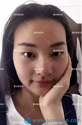 双眼皮+开眼角整形日记为你揭秘:惠州瑞芙臣刘丹虹整形怎么样?