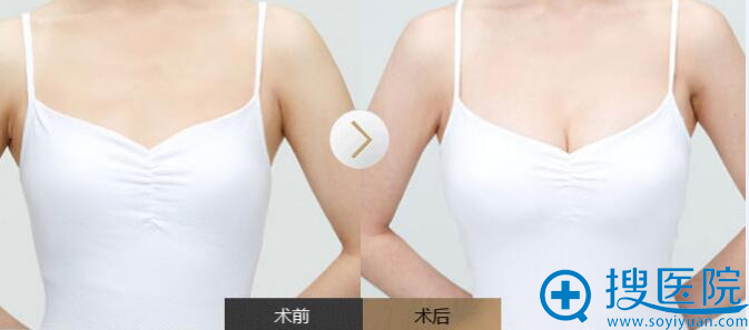 假体丰胸 假体丰胸