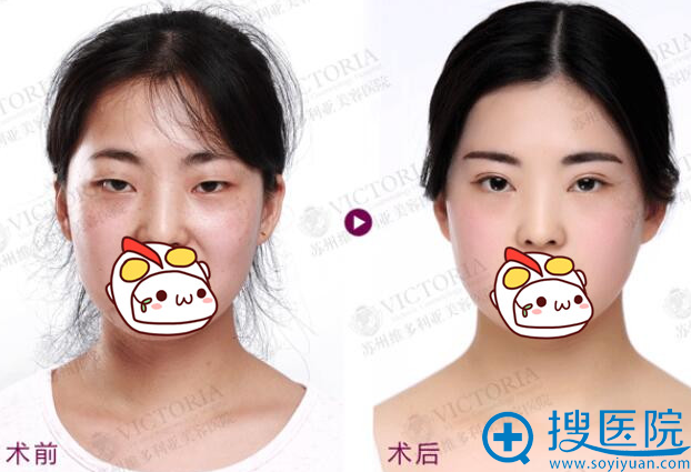 双眼皮+内眼角+上睑下垂 双眼皮+内眼角+上睑下垂