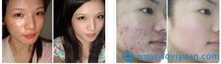 祛痘前后对比效果_<!--<i data=20240710 data-id=14184></i>-->整形医院 祛痘前后对比效果_<!--<i data=20240710 data-id=14184></i>-->整形医院