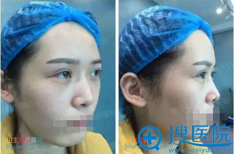 隆鼻术前照片 隆鼻术前照片