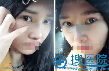 鼻综合术后7天恢复效果 鼻综合术后7天恢复效果