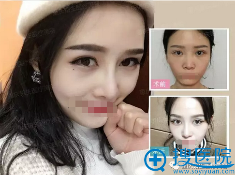 杜亚旭综合隆鼻术后10天对比照片 杜亚旭综合隆鼻术后10天对比照片