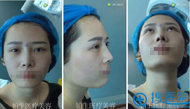 杜亚旭隆鼻术后全方位效果 杜亚旭隆鼻术后全方位效果