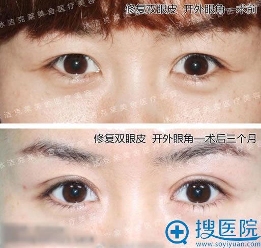张冰洁双眼皮失败修复案例图 张冰洁双眼皮失败修复案例图