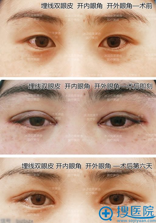 克莱美舍张冰洁埋线双眼皮案例图 克莱美舍张冰洁埋线双眼皮案例图