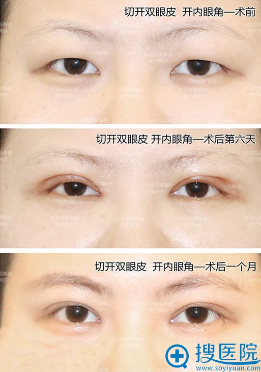 美眼医生张冰洁全切双眼皮手术案例 美眼医生张冰洁全切双眼皮手术案例