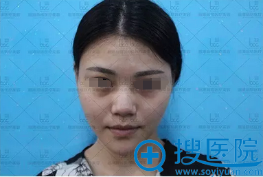 【真实图片】深圳龙岗丽港丽格谢俊:耳软隆鼻综合恢复全过程