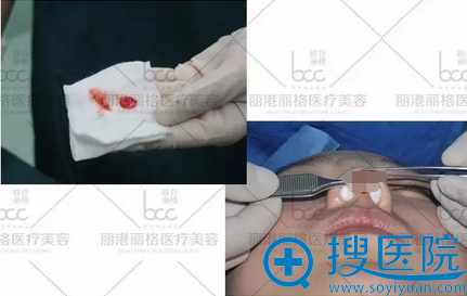 耳软骨鼻综合术中照片 耳软骨鼻综合术中照片