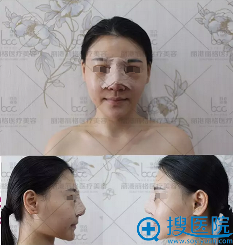 隆鼻术后第二天恢复情况 隆鼻术后第二天恢复情况