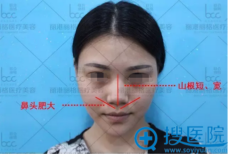 谢俊术前鼻部正面情况分析 谢俊术前鼻部正面情况分析