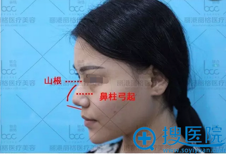 谢俊术前鼻部侧面情况分析 谢俊术前鼻部侧面情况分析