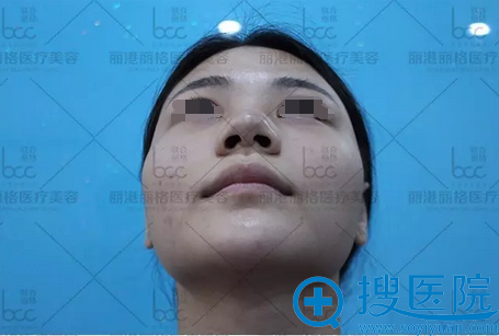 谢俊术前鼻部底端情况分析 谢俊术前鼻部底端情况分析