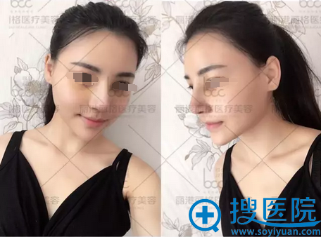 手术一周拆线后恢复图片 手术一周拆线后恢复图片