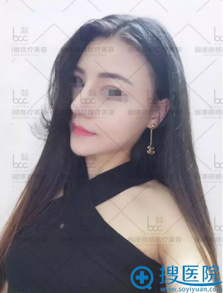 谢俊耳软骨鼻综合术后10天恢复照片 谢俊耳软骨鼻综合术后10天恢复照片