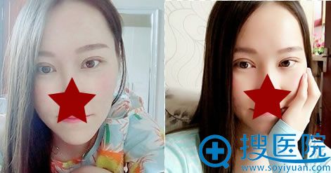 ���ٶ�˫��Ƥ�Ϳ��۽�����һ���»ָ�Ч��