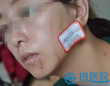 厦门欧菲激光+疤博士治疗疤痕真实案例 为你抹去伤痕找回较初